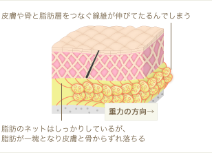 種類２：脂肪繊維の伸びによる、たるみ