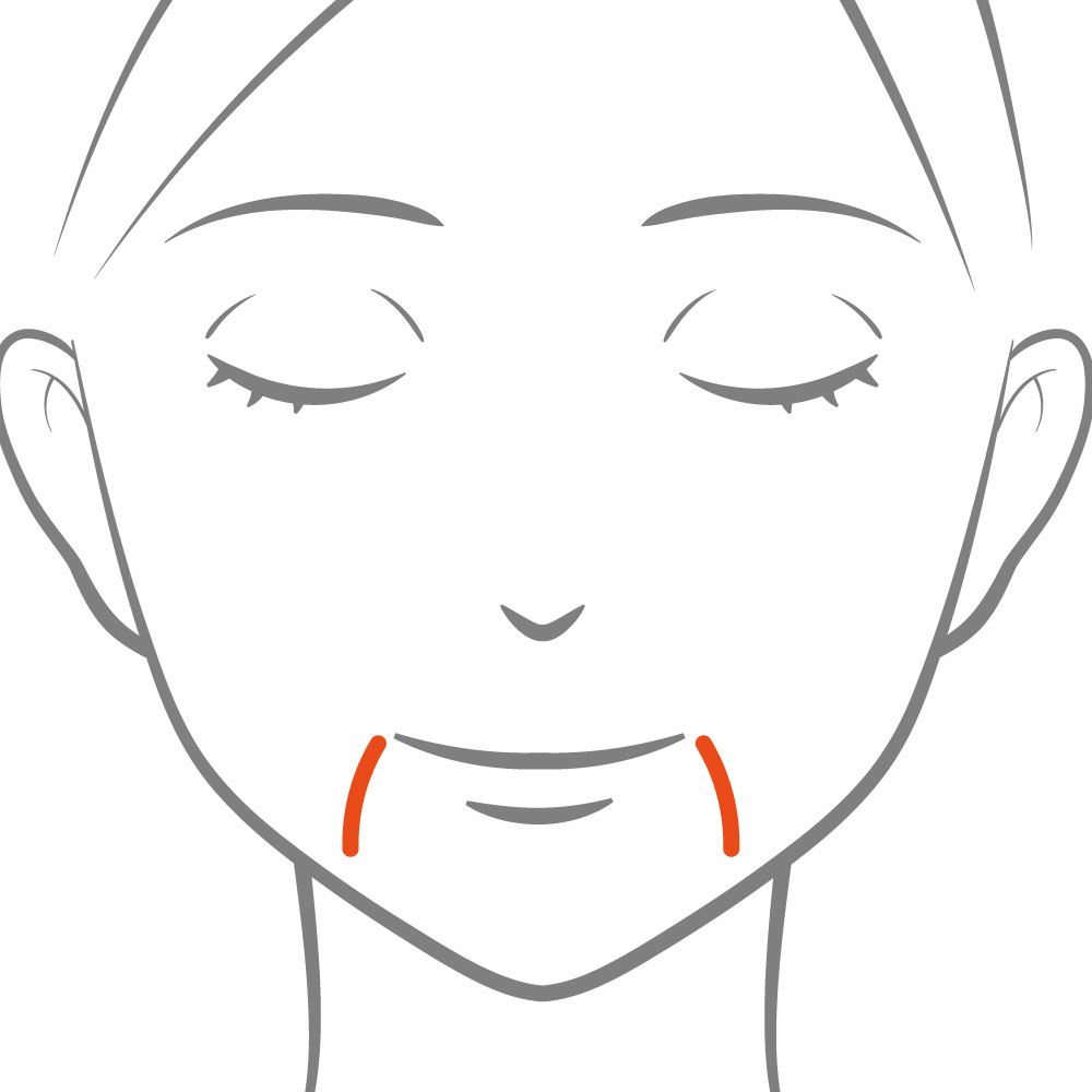 口元のたるみ（マリオネットライン）