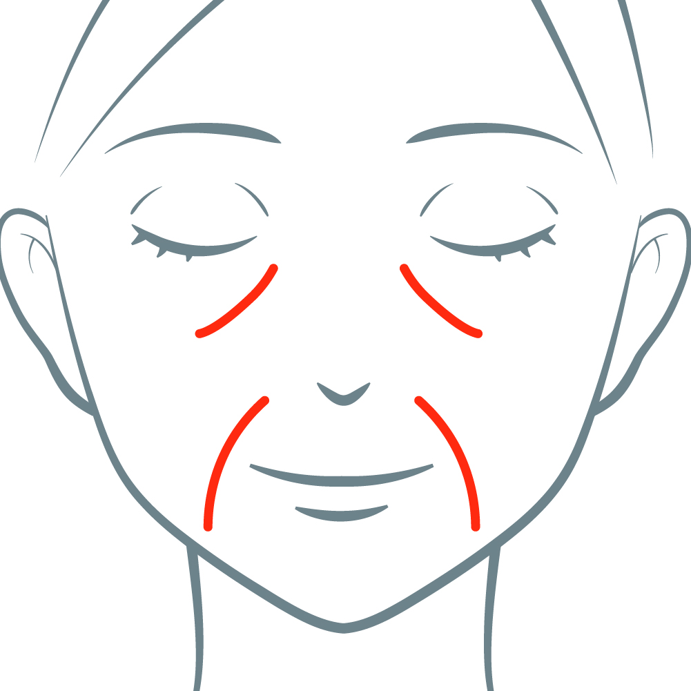 ほうれい線・ゴルゴライン