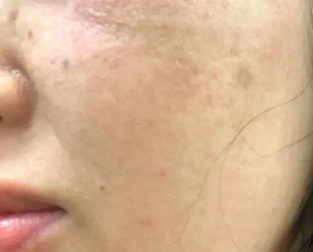 水光注射（ハイコックス）ダウンタイムを少なく治療できる