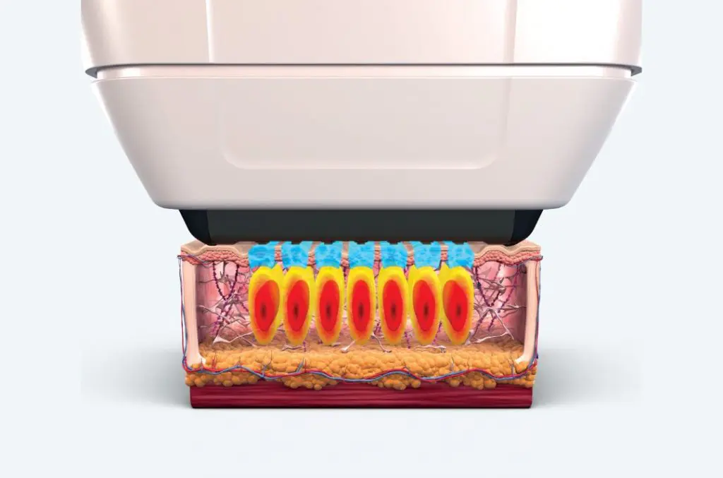 ソフウェーブは痛い？