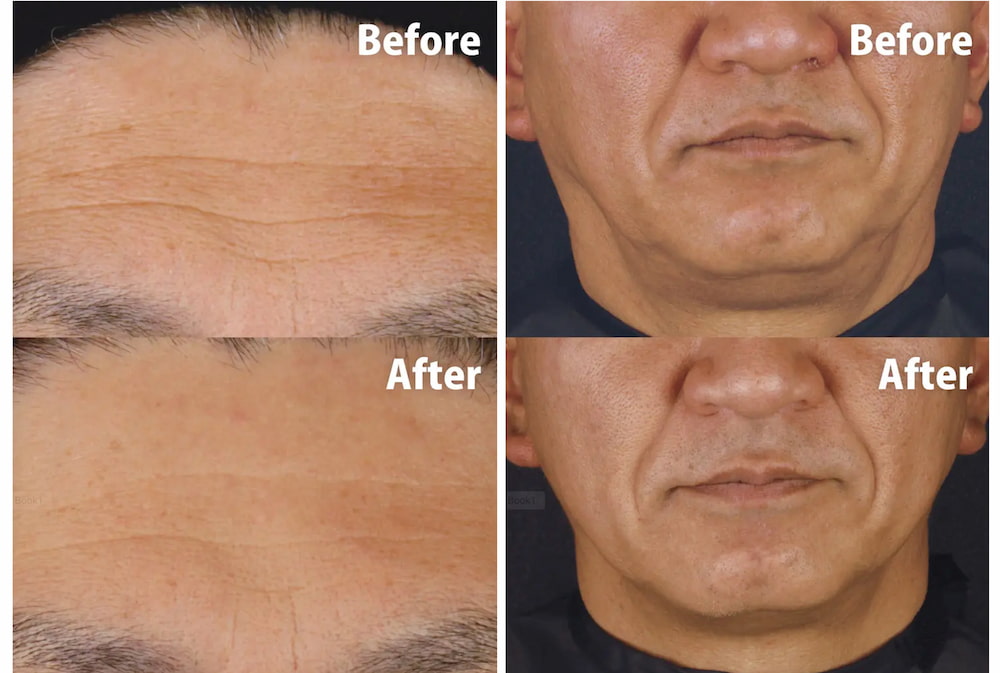 ソフウェーブの症例写真　銀座セオリークリニック