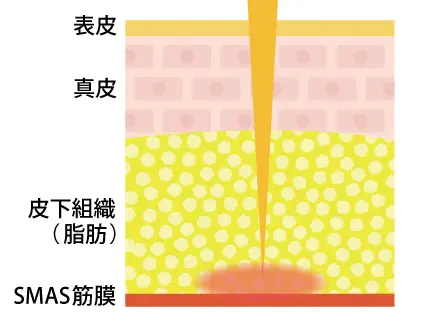 ソフウェーブの照射イメージ