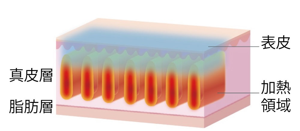 真皮層をターゲットにした治療
