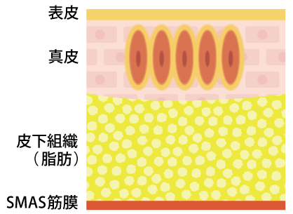 ソフウェーブの照射イメージ