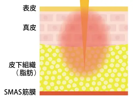 ソフウェーブの照射イメージ