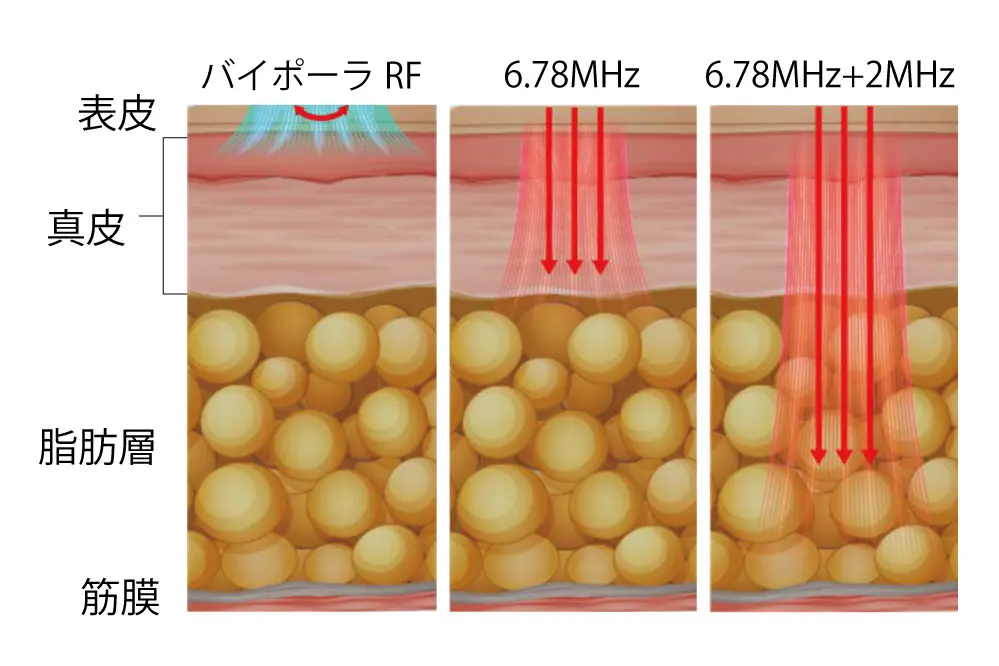 ザーフ（XERF）のマルチ周波数について